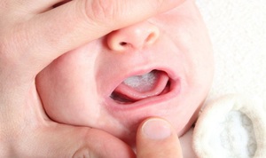 молочниця новонароджений рот лікування комаровский дитина ніж лікувати немовля