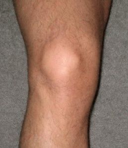вилікувати артроз колінного суглоба