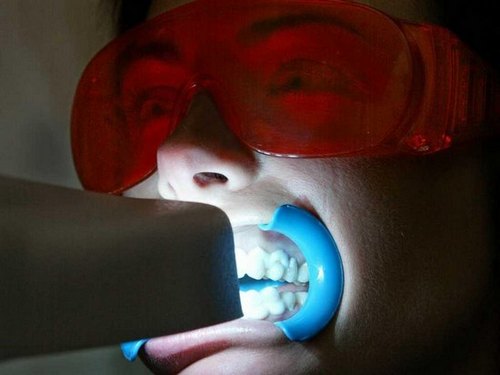 початковий карієс причини стадії біле темна пляма симптоми діагностика лікування профілактика зуб емаль