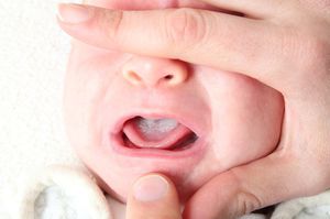 молочниця новонароджений рот лікування сода при чому лікувати немовля немовля