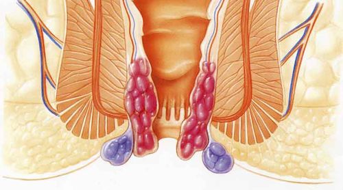 вилікувати шишки геморою