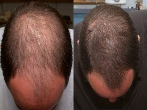 чи можна вилікувати випадання волосся у чоловіків