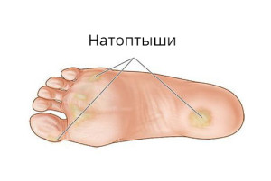 як лікувати шпори і натоптиші