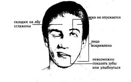 як лікувати розтягнення нерва