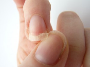 як лікувати нігті на руках які шаруються і ламаються