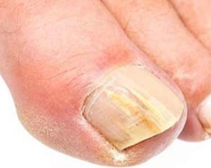 вилікувати грибок нігтів без таблеток