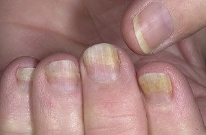як вилікувати хворобу нігтів
