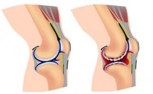 остеопороз колінного суглоба