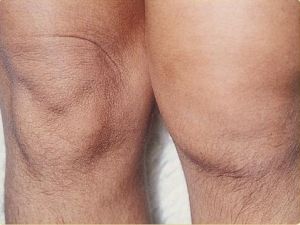 остеопороз колінного суглоба симптоми і лікування