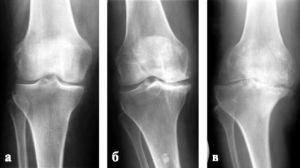 остеопороз колінного суглоба симптоми і лікування