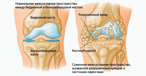 остеохондроз колінного суглоба лікування
