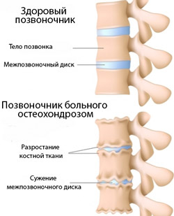 як лікувати остеохондроз у дітей