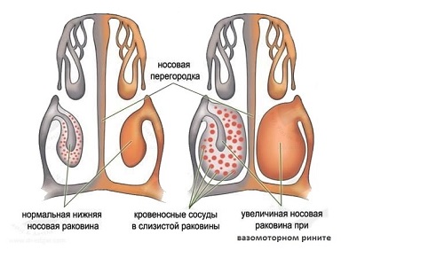 хронічний риніт види