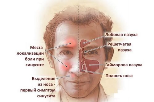 як лікувати гострий гнійний синусит