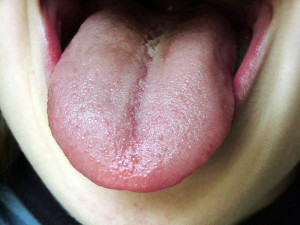 розпух язик