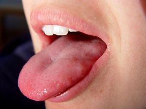 розпух язик