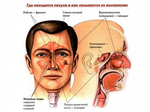 як лікувати синусит гайморит