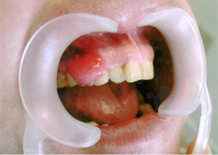 фото і лікування папіломи на слизовій рота