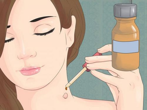 як лікувати папіломи на шиї