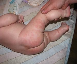 пелюшковий дерматит фото у дітей лікування.