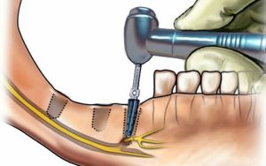 запалення нерва в зубі