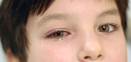 як лікувати очну алергію