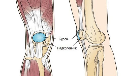 як лікувати препателлярний бурсит