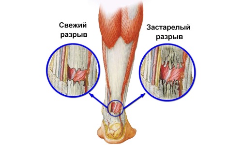 як лікувати розтягнення м'язів гомілки