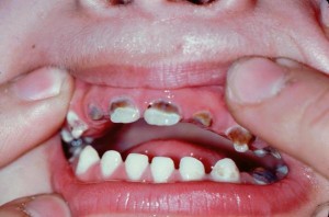 як лікувати карієс корінних зубів