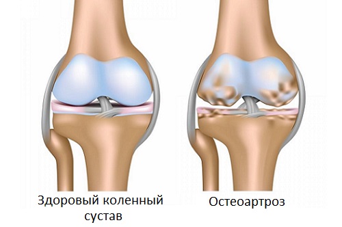 лікувати болять суглоби