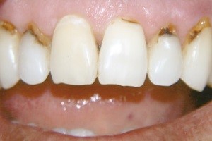 пришийковий карієс передніх зубів