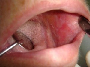 як вилікувати прищі у роті