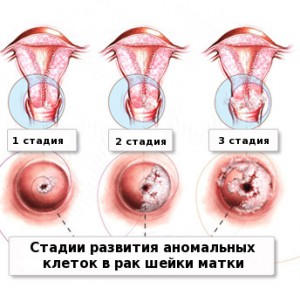 як лікувати рак шийки матки 4 стадії