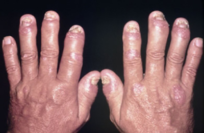 як лікувати псоріаз нігтів на руках
