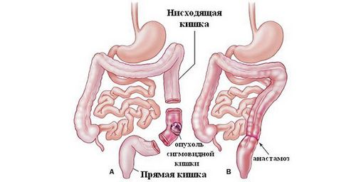 як лікувати рак сигмовидної кишки