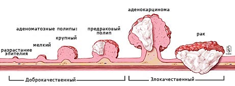 як лікувати рак сигмовидної кишки