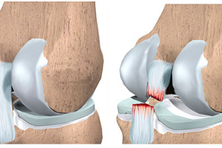 хрестоподібні зв'язки коліна розрив суглоб передній операція лікування пластика аутопластика