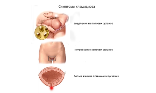 як лікувати повторний хламідіоз