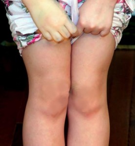 як лікувати ревматизм ніг у дітей