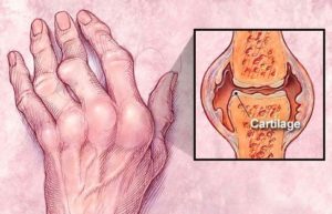 ревматоїдний артрит рук лікування