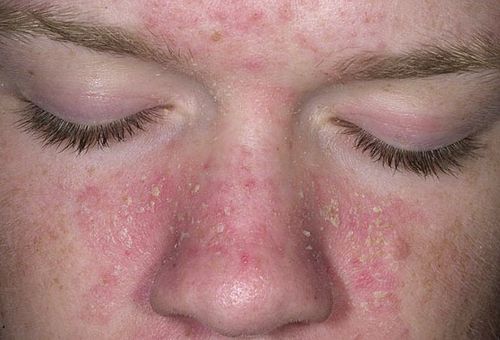 як лікувати себорейний дерматит на обличчі