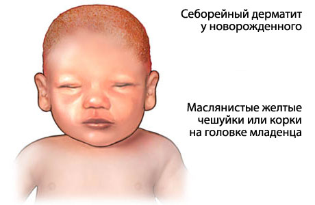 як лікувати себорейний дерматит у немовлят