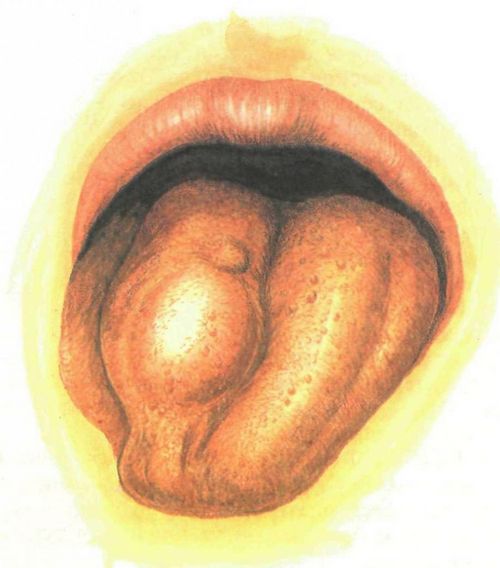сифіліс глотки і порожнини рота