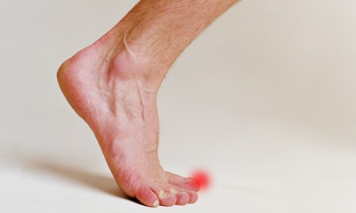 як лікувати розтягнення великого пальця ноги