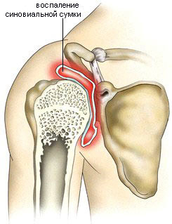 плечовий остеохондроз симптоми суглоб біль
