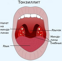 як збити температуру при ангіні у дитини