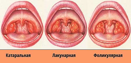 як збити температуру при ангіні у дитини