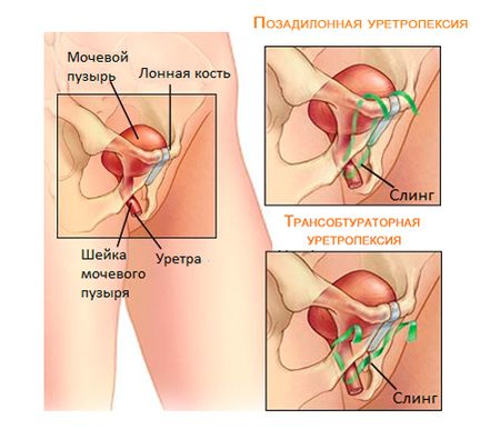 як лікувати енурез у літніх