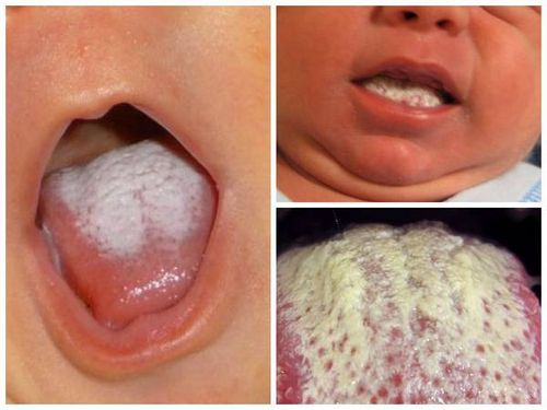 як лікувати кандидоз порожнини рота у дітей