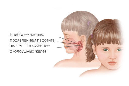 хвороба свинка у дітей симптоми ознаки наслідки у хлопчиків як лікувати проявляється передається